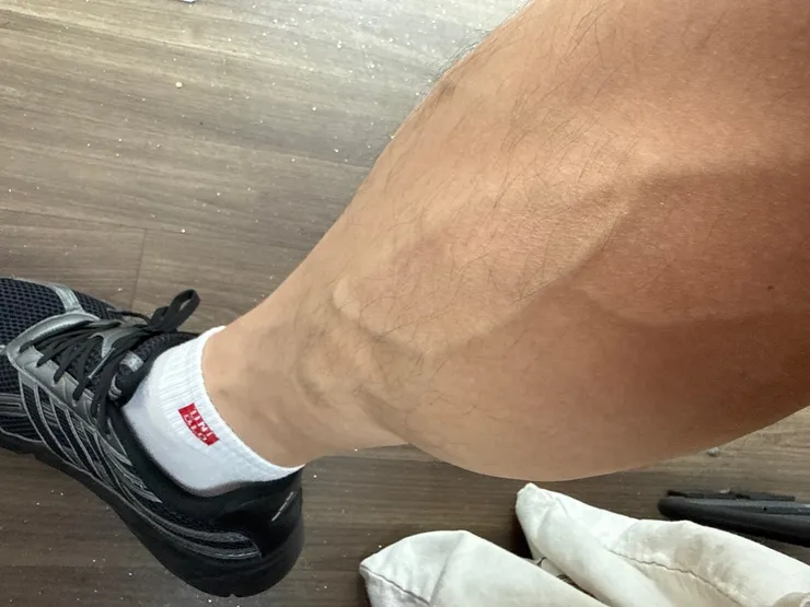 이게하지정맥증상인지 걱정되네요 이미지 2